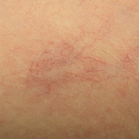 Besenreiser Bein (Laser)