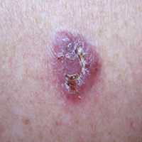Basalzelltumor Rücken