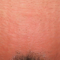 Enthaarung Bikinizone (Laser)
