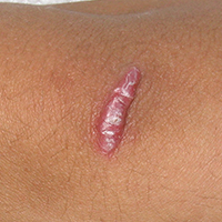 Keloid (Ellenbogen)