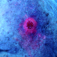 Basalzellkrebs an der linken Schläfe - Fluoreszenzbild